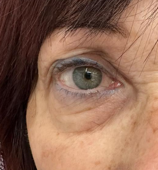 Before-Blefaroplastica non chirurgica