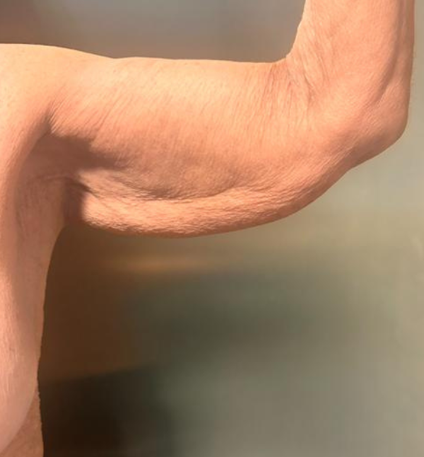 Before-body