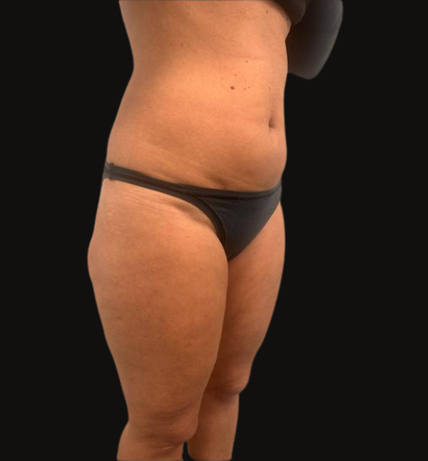 Before-Liposizione